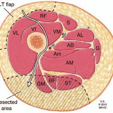 On the anterior side, the most prominent of the muscles are the sartorius muscle and the four muscles that make up quadriceps muscle group (the quads.) An Axial Illustration Of The Proximal Thigh Demonstrating The Anatomy Download Scientific Diagram