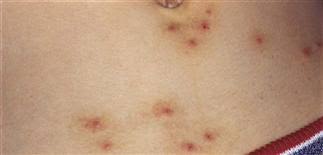 Image result for Papular urticaria