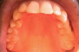 In rare cases, sores or bumps on the roof of the mouth may be cancerous. 8 Reasons Why The Roof Of Your Mouth Is Itchy