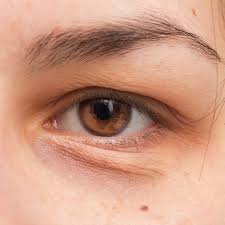 The skin around the eyes is very thin as compared to other parts of the  body, and extremely delicate. Hence, any changes happening in the deeper  layers of the skin will be