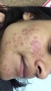 Puteri mardiana the klog • 3 years ago thank you for replying, definitely will wait it out 😀 Differin Purge Pictures