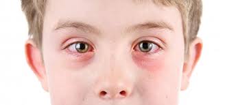 Image result for Allergic Conjunctivitis