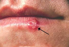Image result for oral herpes symptoms roof of the mouth