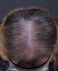 Hair at the top of the head also thins, often progressing to baldness. Sederma New Results On Female Alopecia Cossma