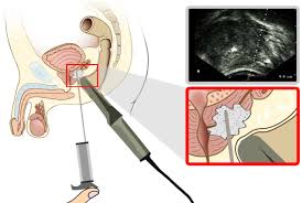 Prostatakreft er ondartede svulster som utgår fra kjertler og ganger i prostatakjertelen. Prostatakreft Store Medisinske Leksikon