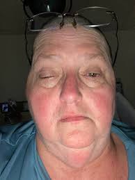 Is Optune's hassle worth the decrease in quality of life?