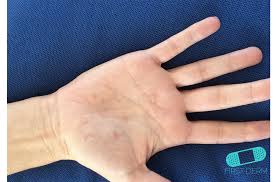 Image result for dyshidrosis