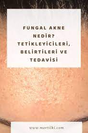 Fungal Akne Mantar Sivilcesi Nedir 2021 Mantar Siyah Ve Beyaz Mor