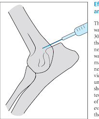 Image result for Elbow Joint Injection