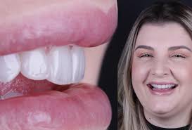 Transformação do sorriso by Dr. Felipe Valverde #lentesdecontatodental