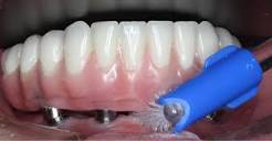 Implantes Dentários – Inova Odontologia