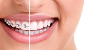 The cost of lingual braces start at approximately $7,500 for a single arch and from $12,500 for a full treatment. Growth Orthodontics Orthodontics Dentalplus Tauranga
