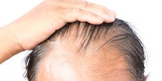 Some people lose hair in circular or patchy bald spots on the scalp, beard or eyebrows. 10 Things You Should Know About Male Hair Loss
