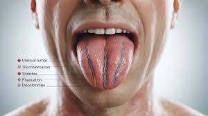 Image result for cancer of tongue