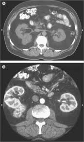Renal and extrarenal actions of klotho. Renal Cell Carcinoma The Lancet