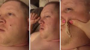 Watch This Gruesome Video of a Four-Year-Old Pimple Being Popped