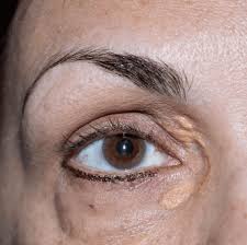 Image result for xanthelasma of eyelid