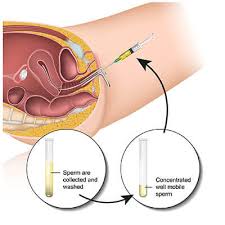 I was so excited to get started with the process and have our first iui, but once the first one was unsuccessful, that excitement had worn off. Trigger Shot Iui Intrauterine Insemination Iui Succes Rates