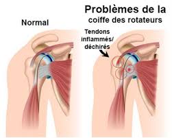 Comment cela c'est il passé pourriez vous me donner quelques informations. Rupture De La Coiffe Des Rotateurs Symptomes Traitement Definition Docteurclic Com