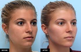 This depends on the type of filler used and your unique physiology. Defining The Jaw Jawline With Fillers In San Francisco Dr David Mabrie Mabrie Facial Institute