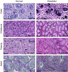 Therapy Of Endocrine Disease Testicular Function And Fertility In Men With Klinefelter Syndrome A Review In European Journal Of Endocrinology Volume 168 Issue 4 2013