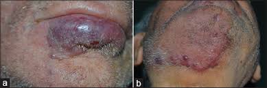 Merkel cell carcinoma is a highly aggressive primary cutaneous neuroendocrine carcinoma primarily affecting elderly and immunosuppressed individuals. Indian Journal Of Dermatology Venereology And Leprology Metastatic Merkel Cell Carcinoma Of The Face