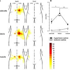 Body Chart A Showing Superimposed Pain Distributions After