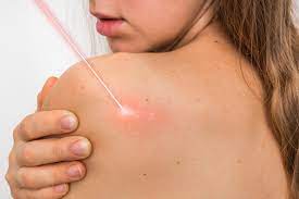 Quitar Verrugas Y Eliminar Lunares Con Laser Co2 Fuera De Tu Cuerpo
