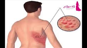 مرض الزونا سببه بوشويكة Youtube
