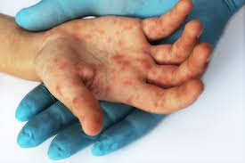 Bintiknya tu kecil tapi agak perih jg kalo disentuh , ga gatel. Petechiae Bintik Serupa Ruam Di Kulit Hello Sehat