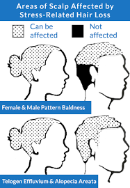 Hair loss can be caused by shock, trauma to your body (like undergoing surgery or being in a car accident), poor nutrition, chronic stress, regularly taking it's also directly linked to hair loss. What Can I Use To Regrow Hair After Hair Loss Caused By Stress