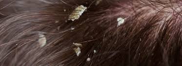 Seborrheic dermatitis may also cause hair loss by allowing certain types of fungi to multiply on your skin. How Eczema On Your Scalp Could Lead To Hair Loss Hair Transplant Dubai
