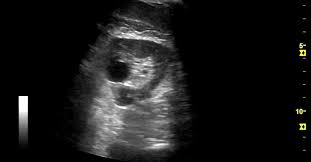 Learning Radiology Room - Renal Failure Sonography | Facebook