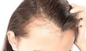 My doctor ran a bunch of blood tests (thyroid, ana, prolactin, serum ferritin, cbc) but said everything was normal and diagnosed it as te due to stress. Protein Deficiency Symptoms Signs To Add More Protein Foods In Diet Express Co Uk