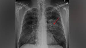 Menurut national cancer institute, sebanyak 100,000 kes didiagnosis di amerika syarikat setiap tahun. Bagaimana Cara Pneumonia Sebabkan Kematian Gaya Tempo Co