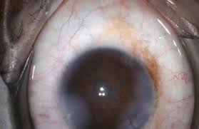 Localised Corneal Haze And Scarring Following Pulsed Accelerated Collagen  Cross-Linking For Keratoconus | Eye