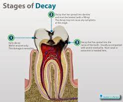 Pediatric Dentist Bangalore Root Canal Treatment For Baby Teeth Pulpectomy