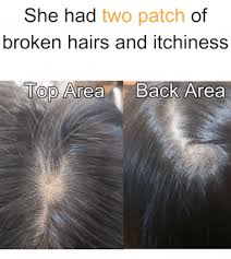 Lichen planus is a skin condition that can cause discoloration of the scalp, as well as hair loss. Effective Treatment To Get Rid Of Patchy Hair Loss And Itchy Scalp Bee Choo Ladies