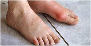 Image result for gout symptoms toe