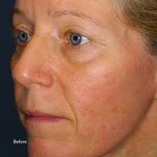 Anti-Redness Serum For Rosacea Prone Skin