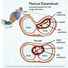 Image result for Pectus Excavatum