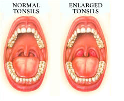 9 Natural Remedies For Tonsillitis Swollen Tonsils Tonsils And Adenoids Remedies For Swollen Tonsils Swollen Tonsils