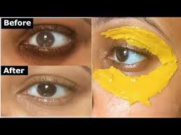 How To Get Rid Of Dark Circles Under Your Eyes Immediately Naturally With 13 Home Remedies 9 Diy Eye Crea Remove Dark Circles Turmeric Mask Dark Eye Circles