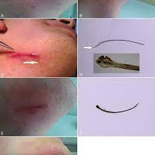 These ingrown hairs are most common people with curly hair and they appear often in legs, beard area, bikini area and legs. The Presentations Of Ingrowing Hair A 4 3 Cm Long Black Linear Lesion Download Scientific Diagram