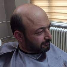 Frenchair Trabzon Ile Legend Hair Frenchair Trabzon Saclandirma Sistemleri