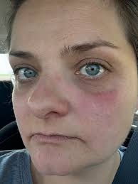 Timing of Antiviral Treatment for Shingles