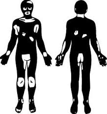 Facts About Vitiligo American Vitiligo Research Foundation Vitiligo Description Explanation Classification Meaning Vitiligo Treatment Vitiligo Vitiligo Cure
