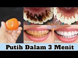 Cara Memutihkan Gigi Kuning Dirumah Dalam Beberapa Menit Saja Youtube Pemutih Gigi Gigi Obat Alami