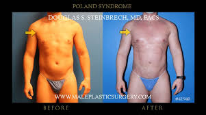 The severity of poland syndrome is variable, and it is possible for mild cases not to be evident until puberty when breast. Blog News And Resources On Male Plastic Surgery Archives Male Plastic Surgerymale Plastic Surgery
