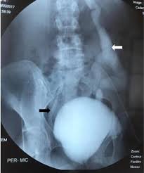Bilateral Duplex Collecting System With Bilateral Vesicoureteral Reflux A Case Report Journal Of Medical Case Reports Full Text